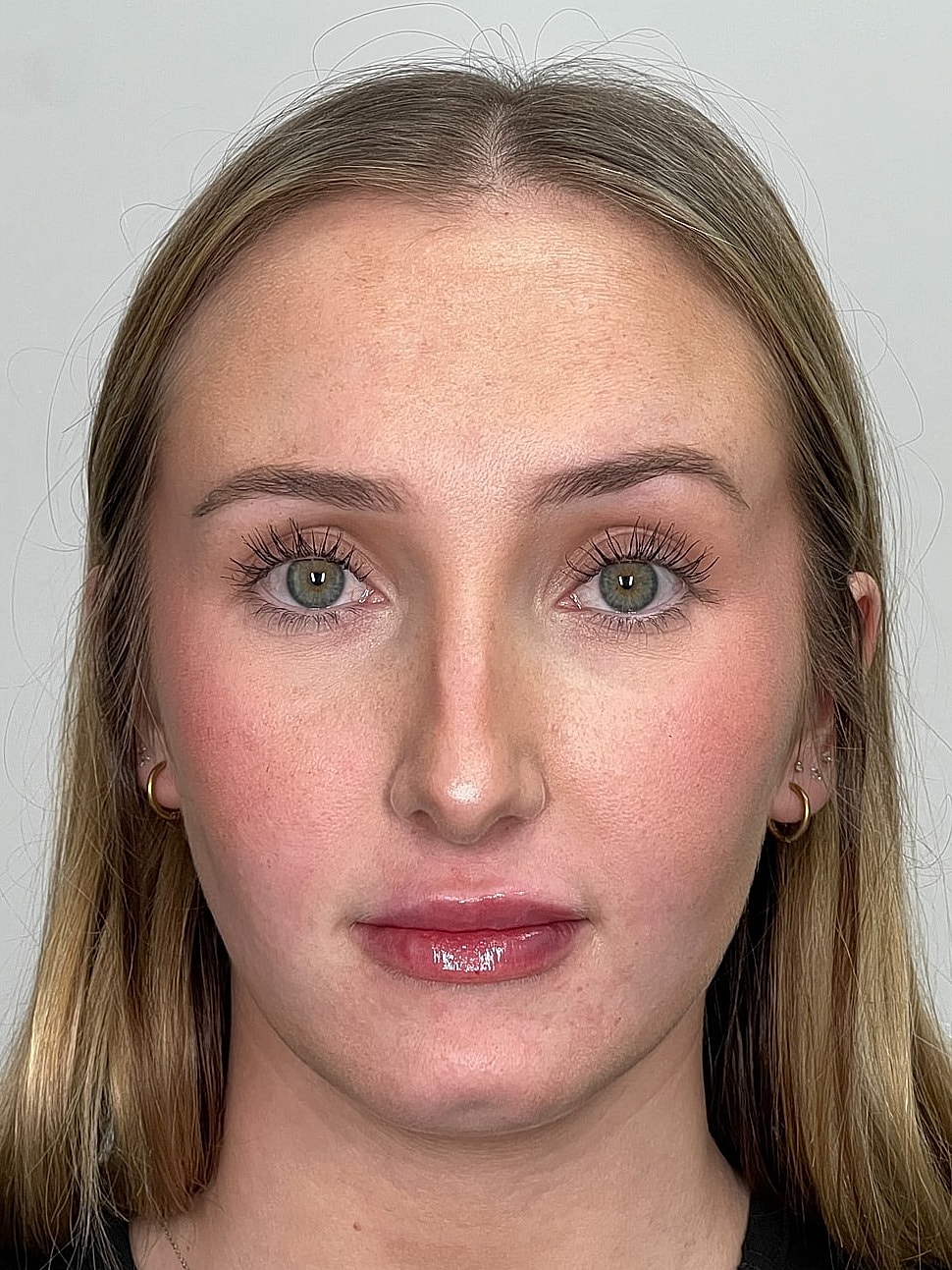 Lip Enhancement Gallery Before & After