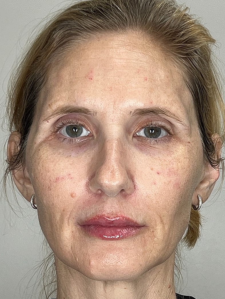 Lip Enhancement Gallery Before & After