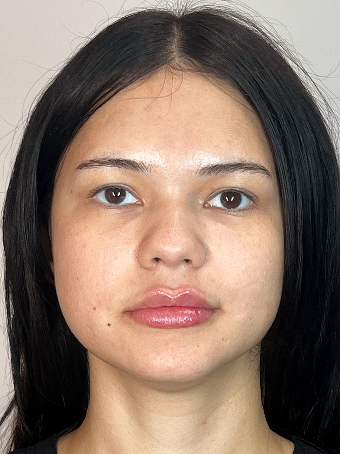 Lip Enhancement Gallery Before & After
