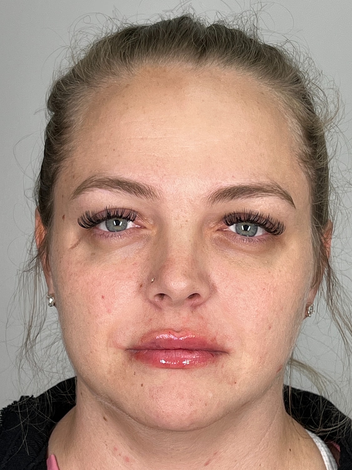 Lip Enhancement Gallery Before & After
