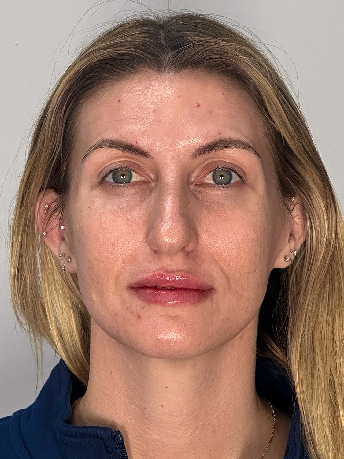 Lip Enhancement Gallery Before & After