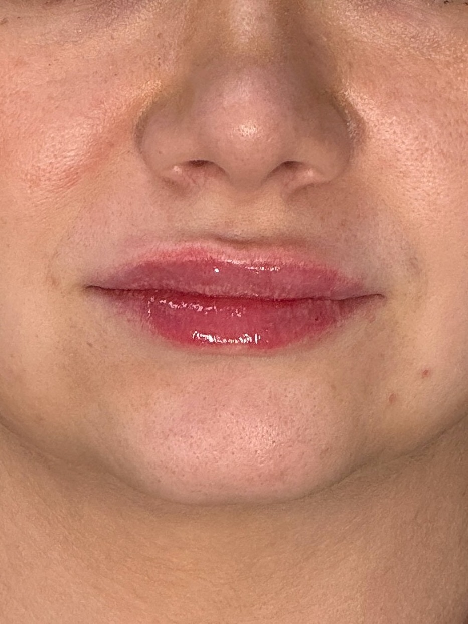 Lip Enhancement Gallery Before & After