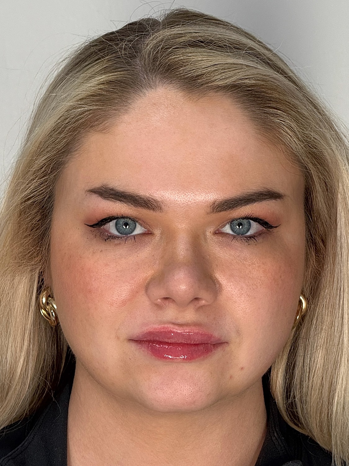 Lip Enhancement Gallery Before & After