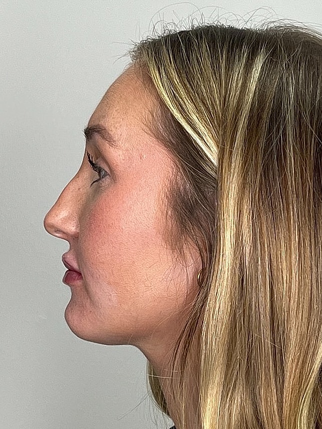 Lip Enhancement Gallery Before & After
