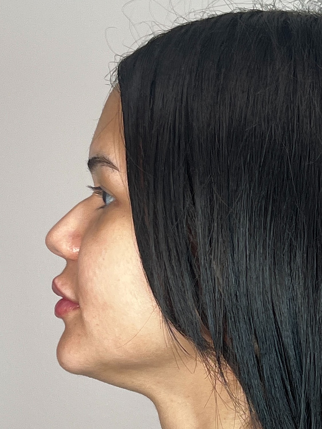 Lip Enhancement Gallery Before & After