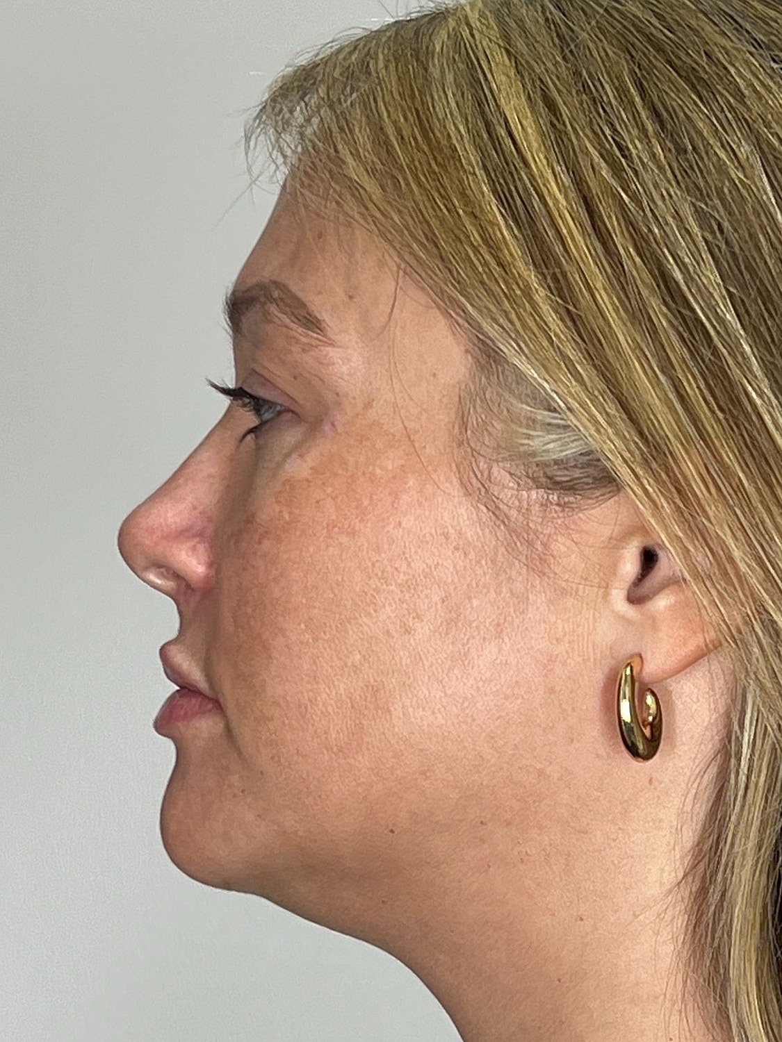 Lip Enhancement Gallery Before & After