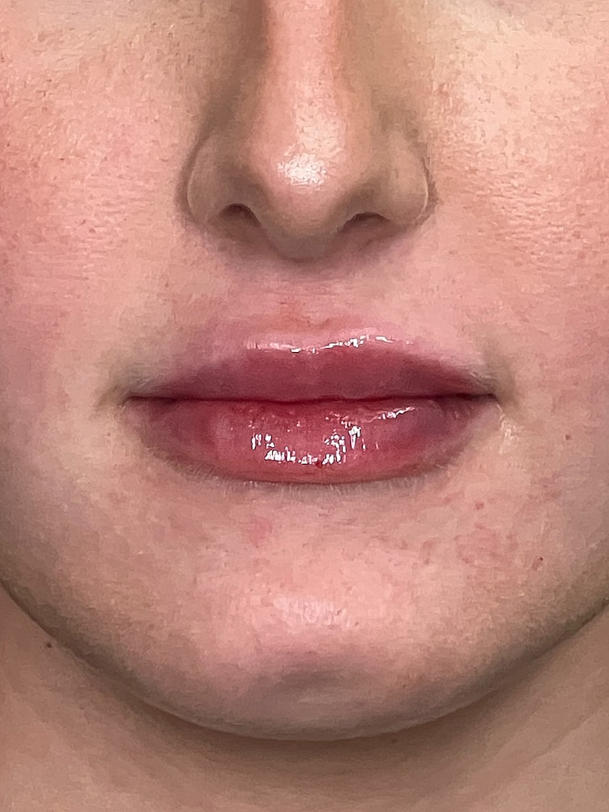 Lip Enhancement Gallery Before & After