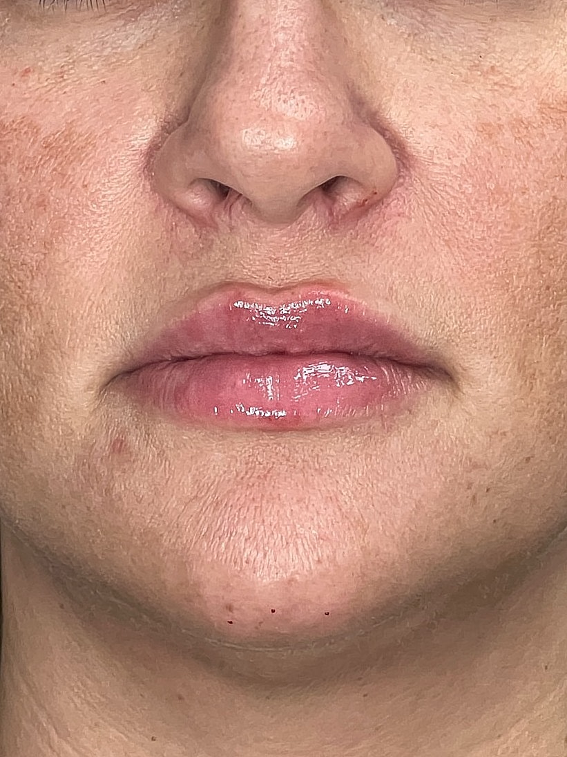 Lip Enhancement Gallery Before & After