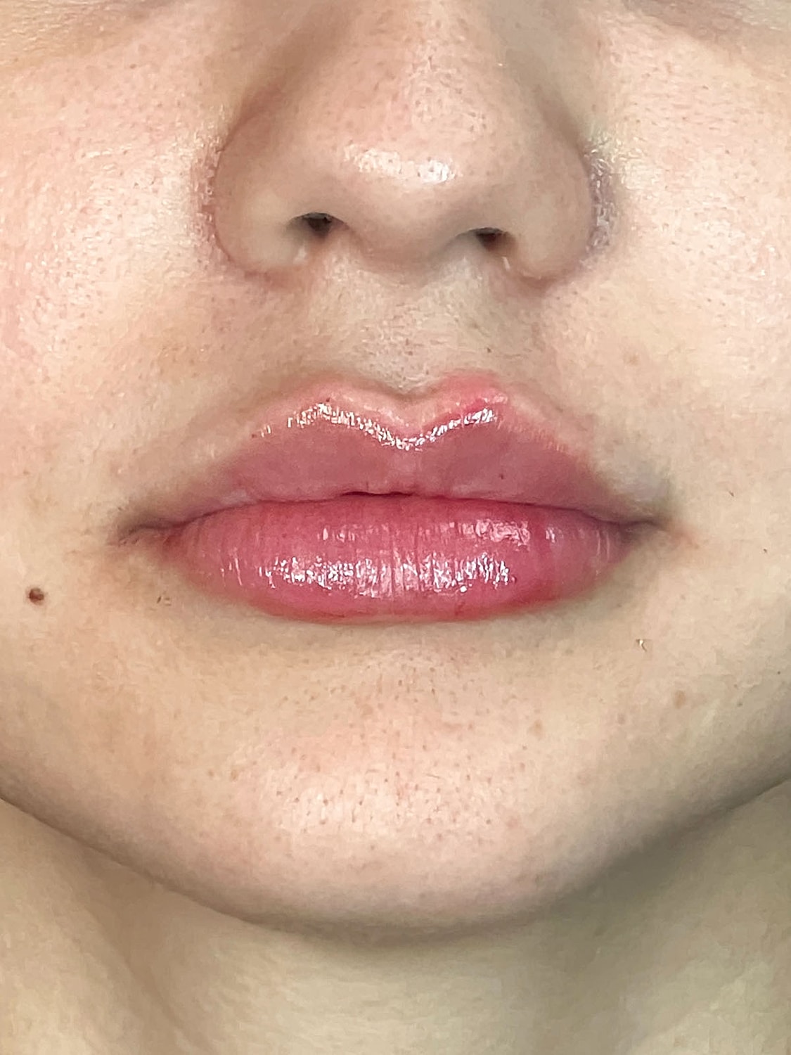 Lip Enhancement Gallery Before & After