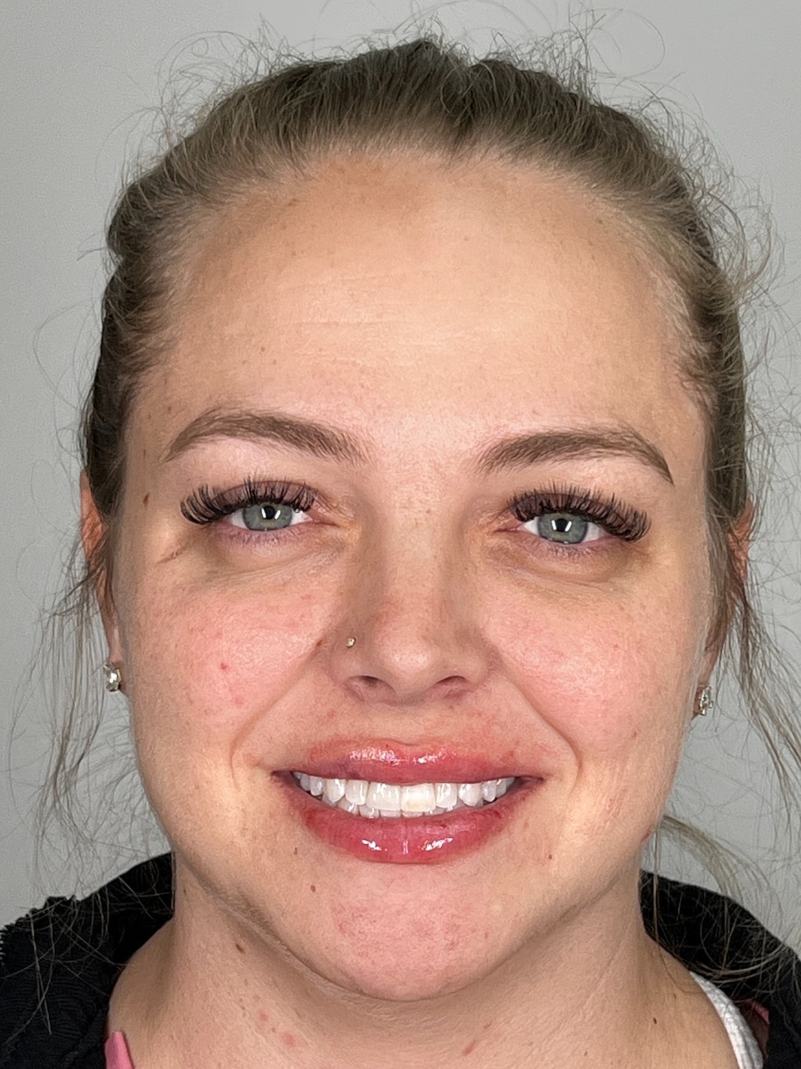 Lip Enhancement Gallery Before & After