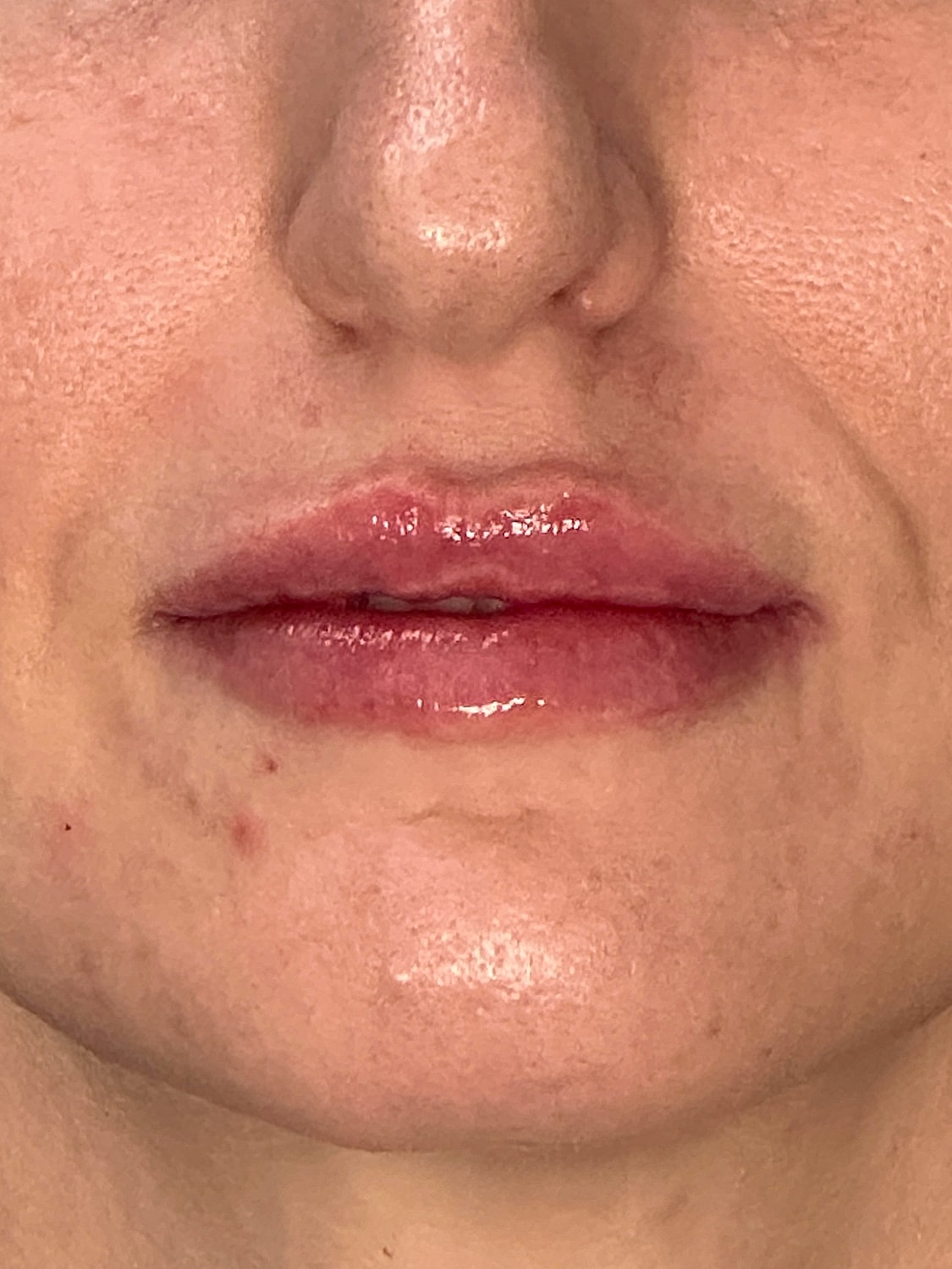 Lip Enhancement Gallery Before & After
