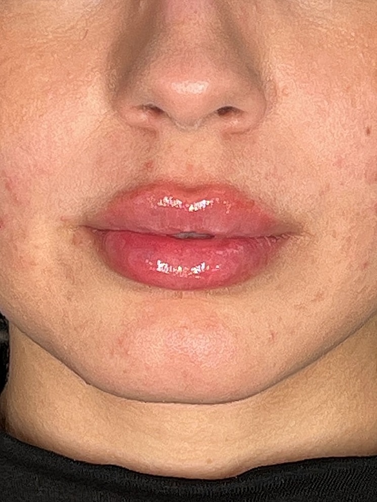Lip Enhancement Gallery Before & After