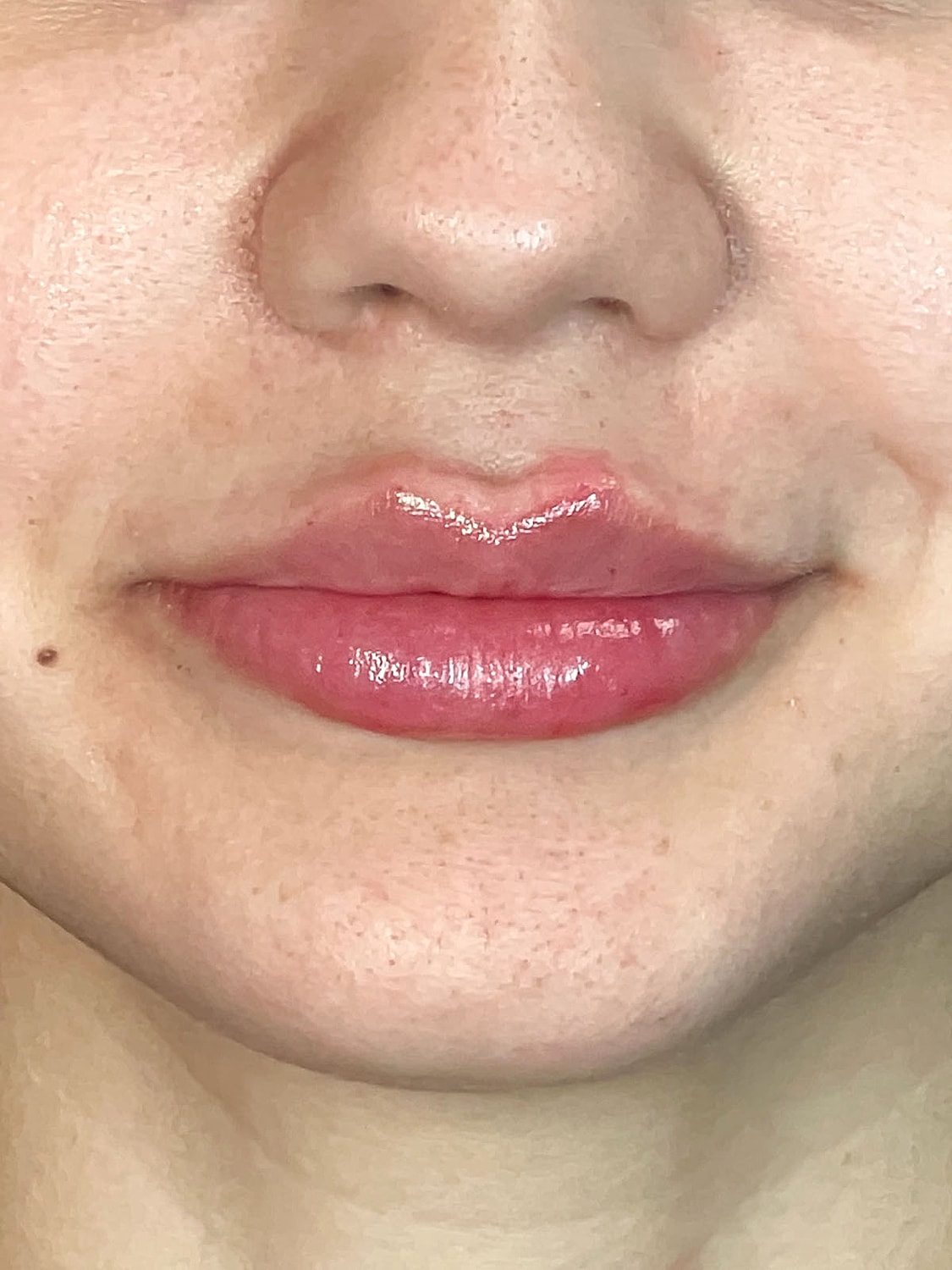 Lip Enhancement Gallery Before & After