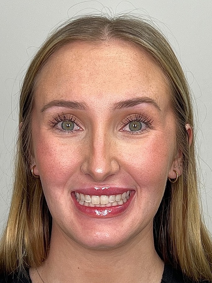 Lip Enhancement Gallery Before & After