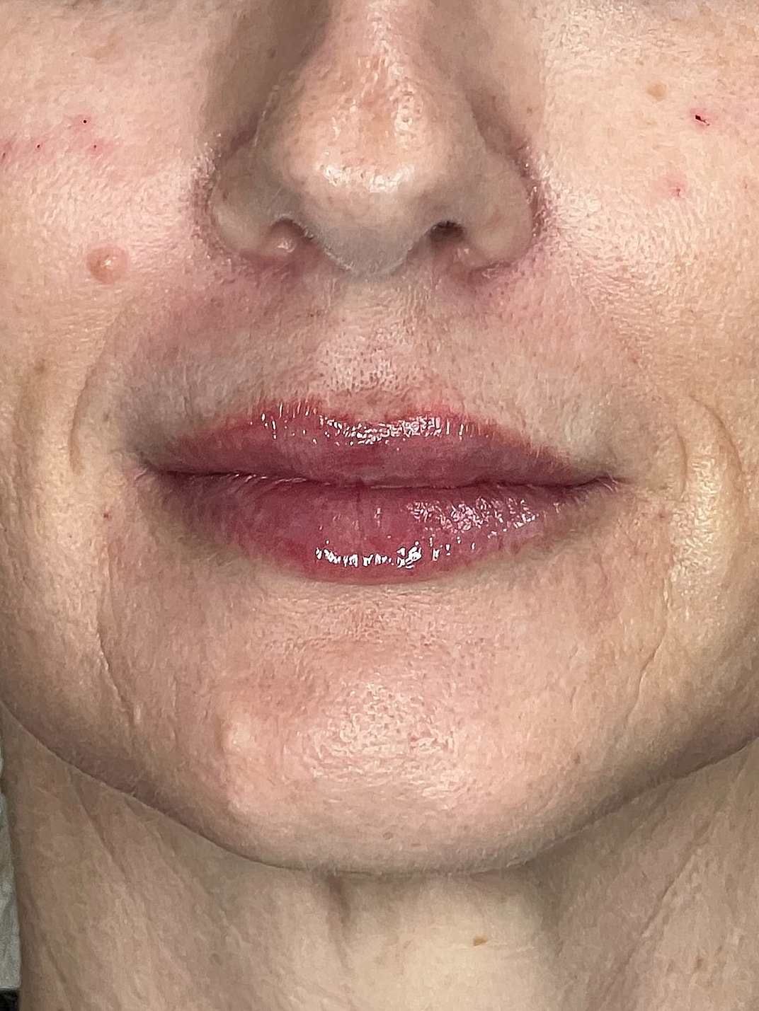 Lip Enhancement Gallery Before & After