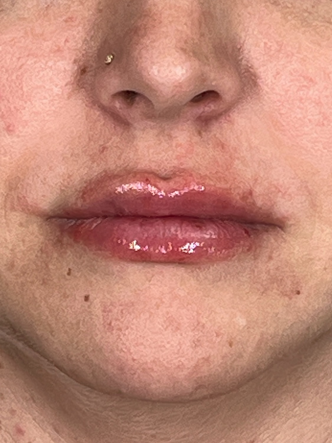 Lip Enhancement Gallery Before & After
