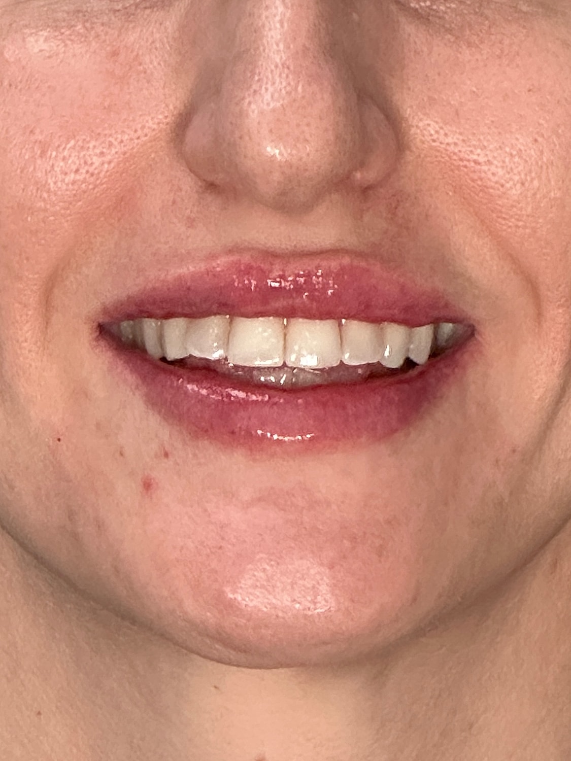 Lip Enhancement Gallery Before & After