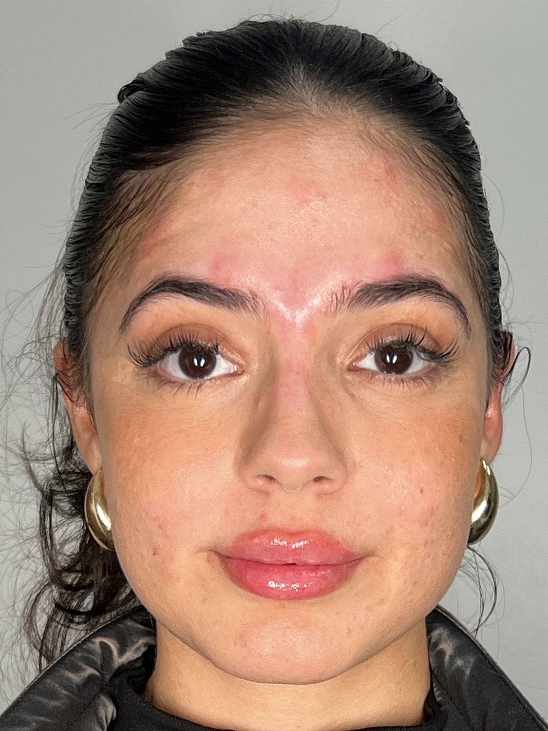 Lip Enhancement Gallery Before & After