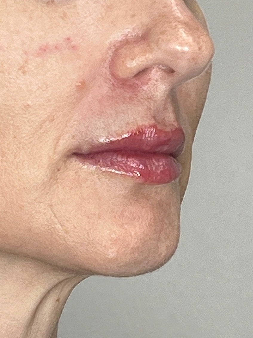 Lip Enhancement Gallery Before & After