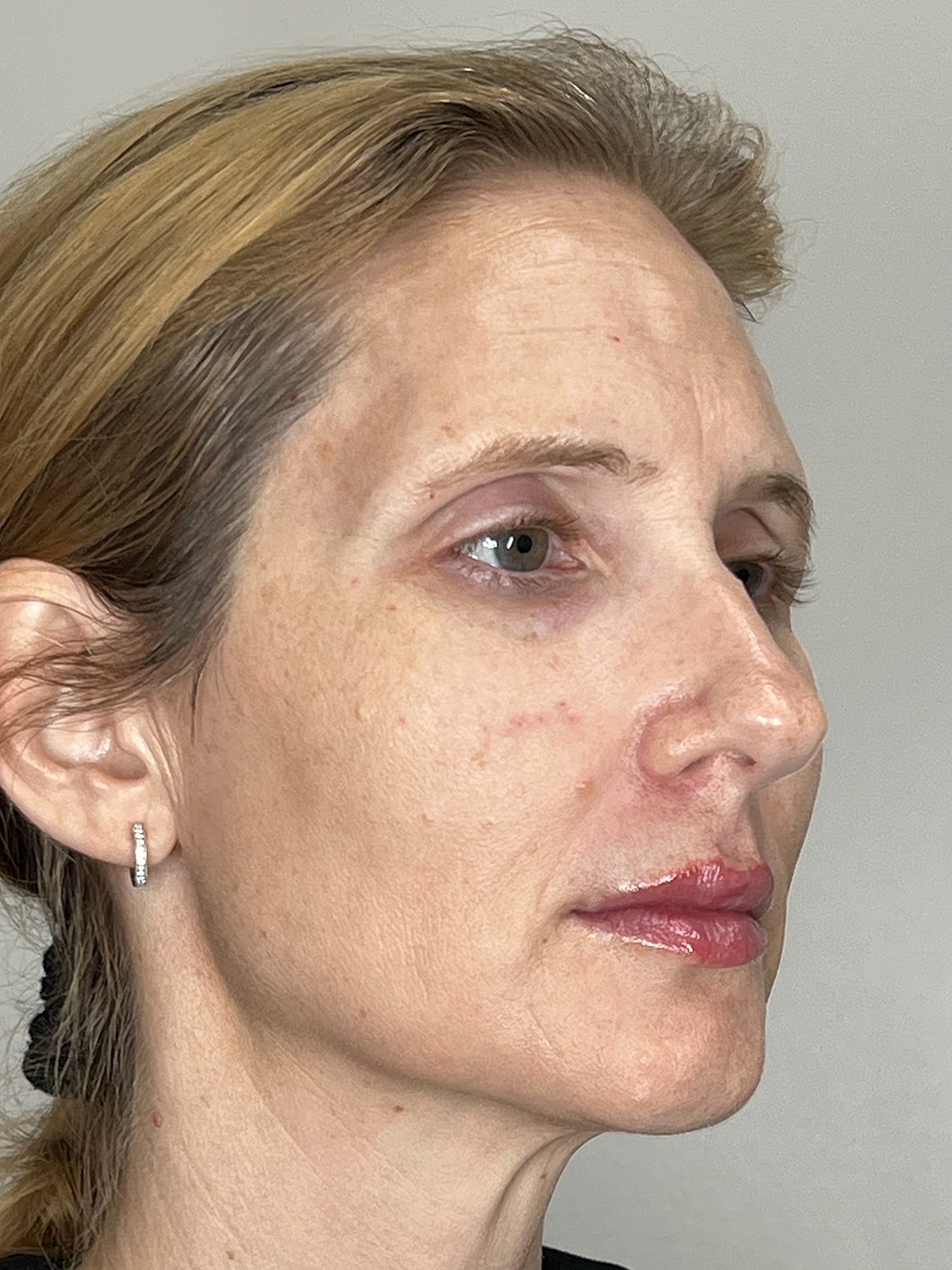 Lip Enhancement Gallery Before & After