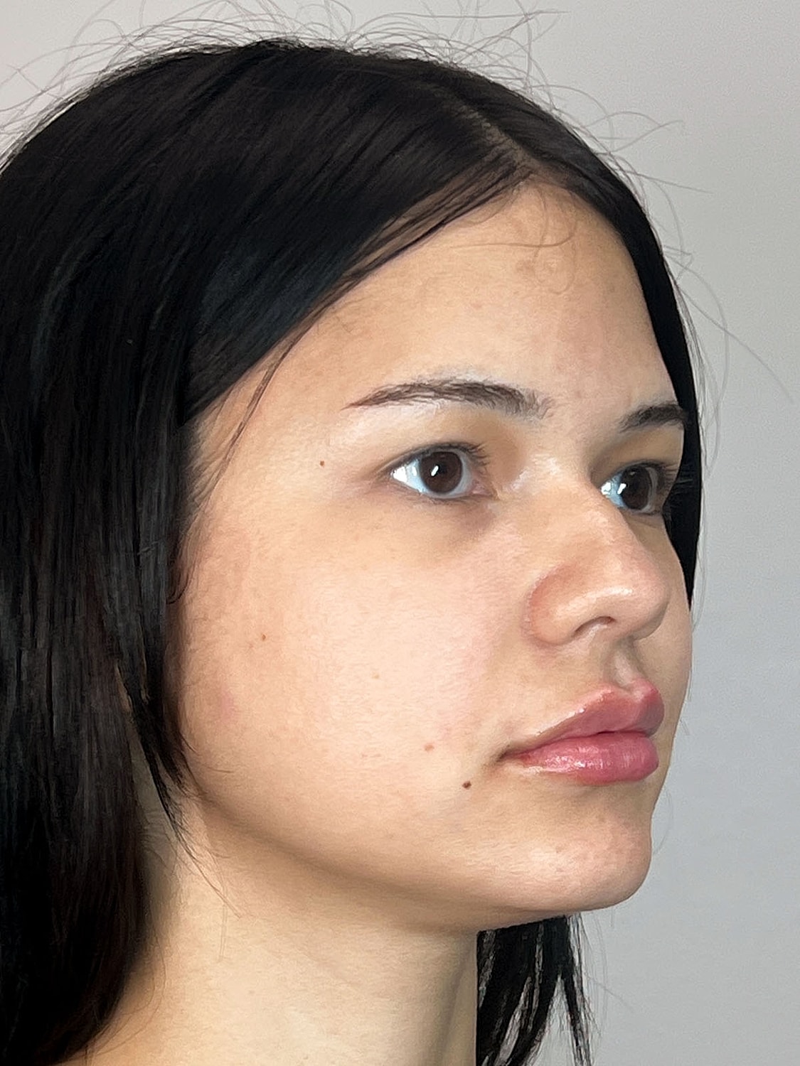 Lip Enhancement Gallery Before & After