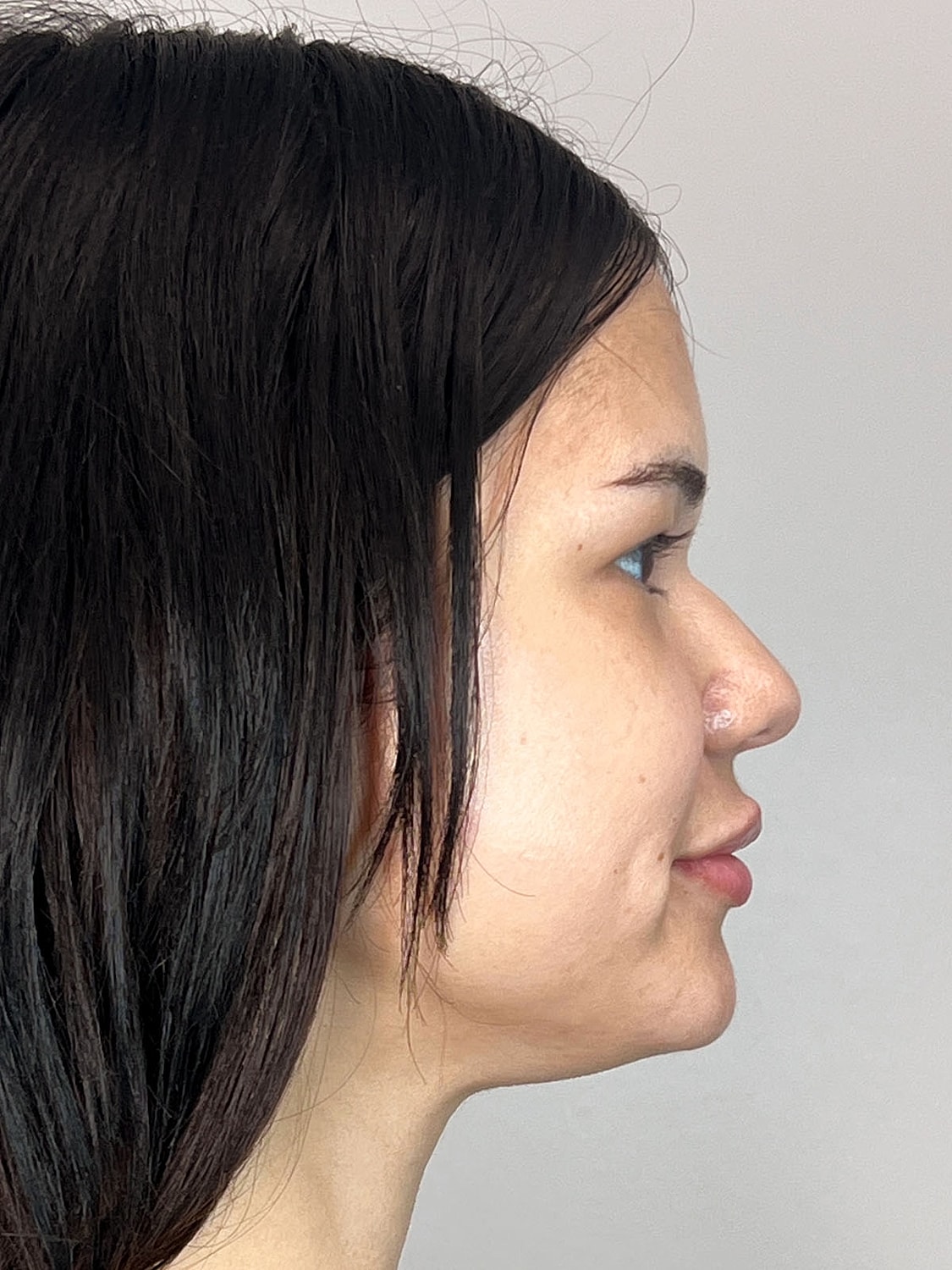 Lip Enhancement Gallery Before & After