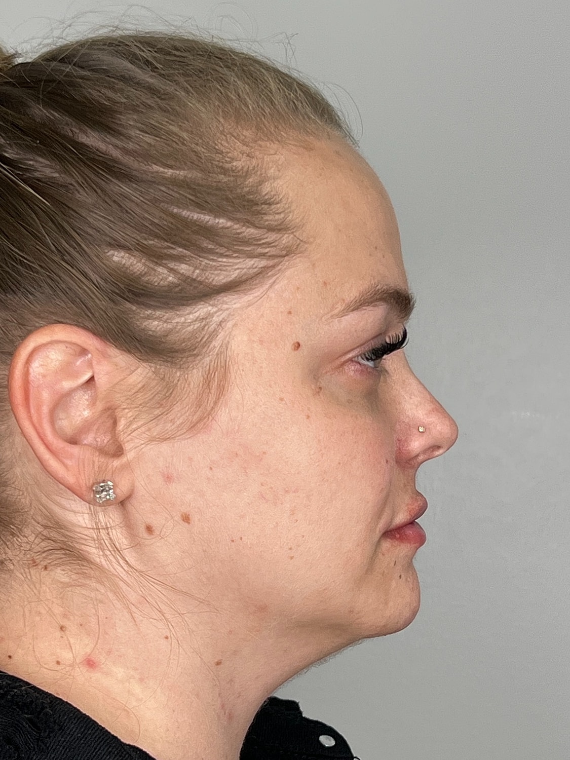 Lip Enhancement Gallery Before & After