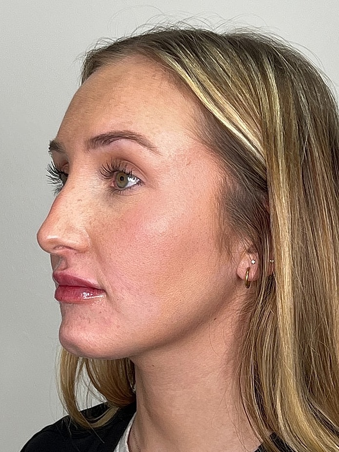 Lip Enhancement Gallery Before & After