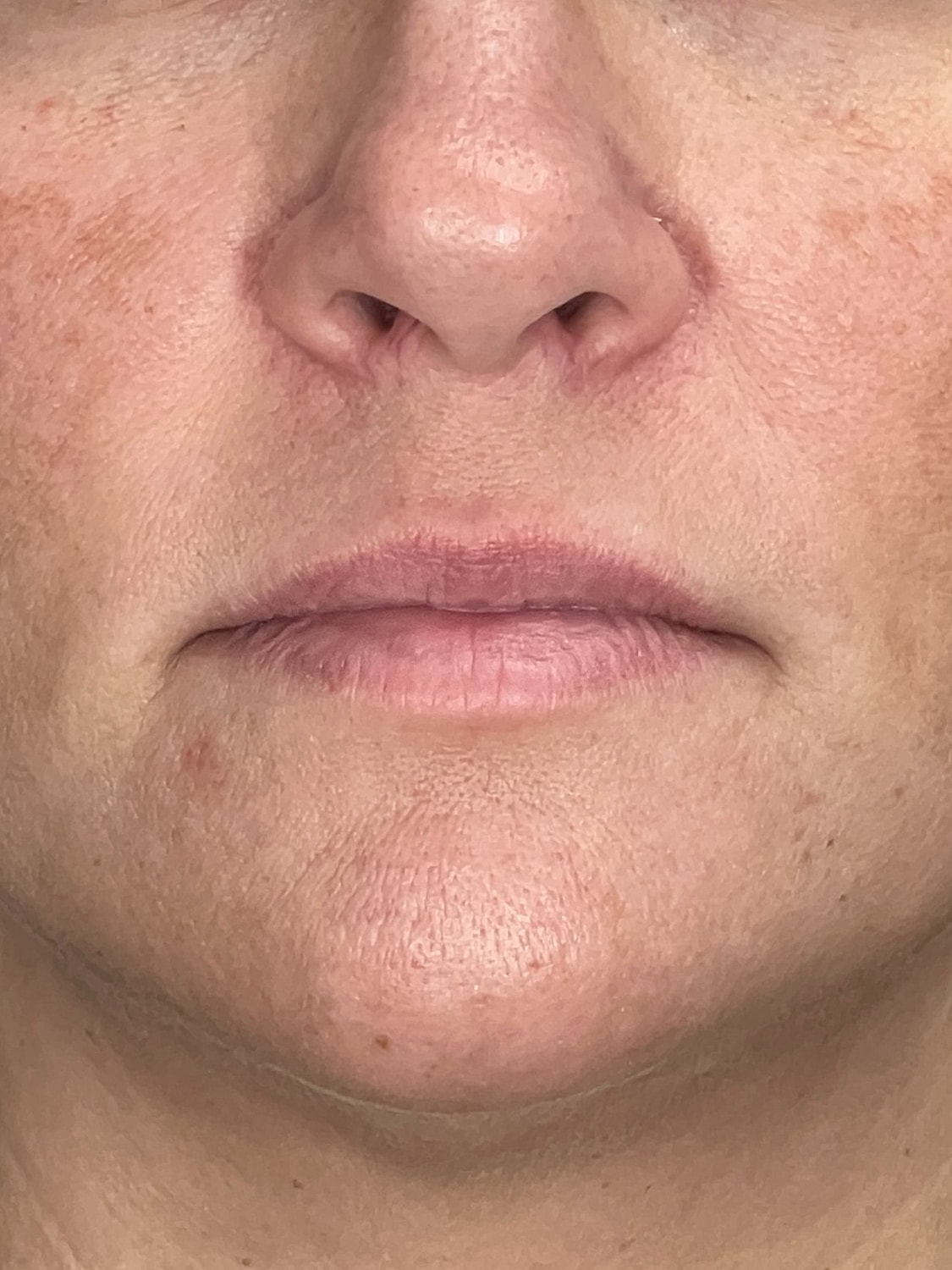Lip Enhancement Gallery Before & After