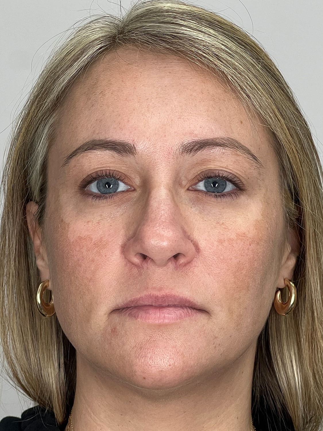 Lip Enhancement Gallery Before & After