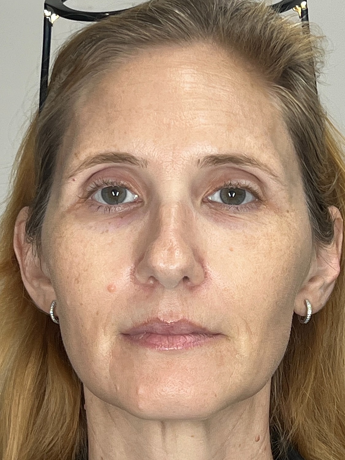 Lip Enhancement Gallery Before & After