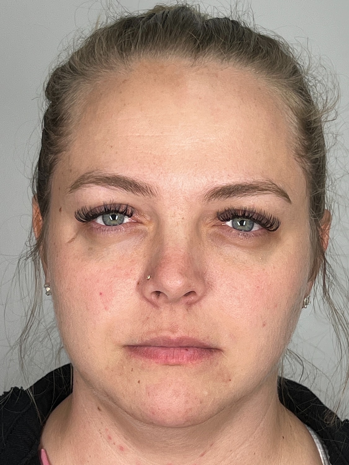 Lip Enhancement Gallery Before & After