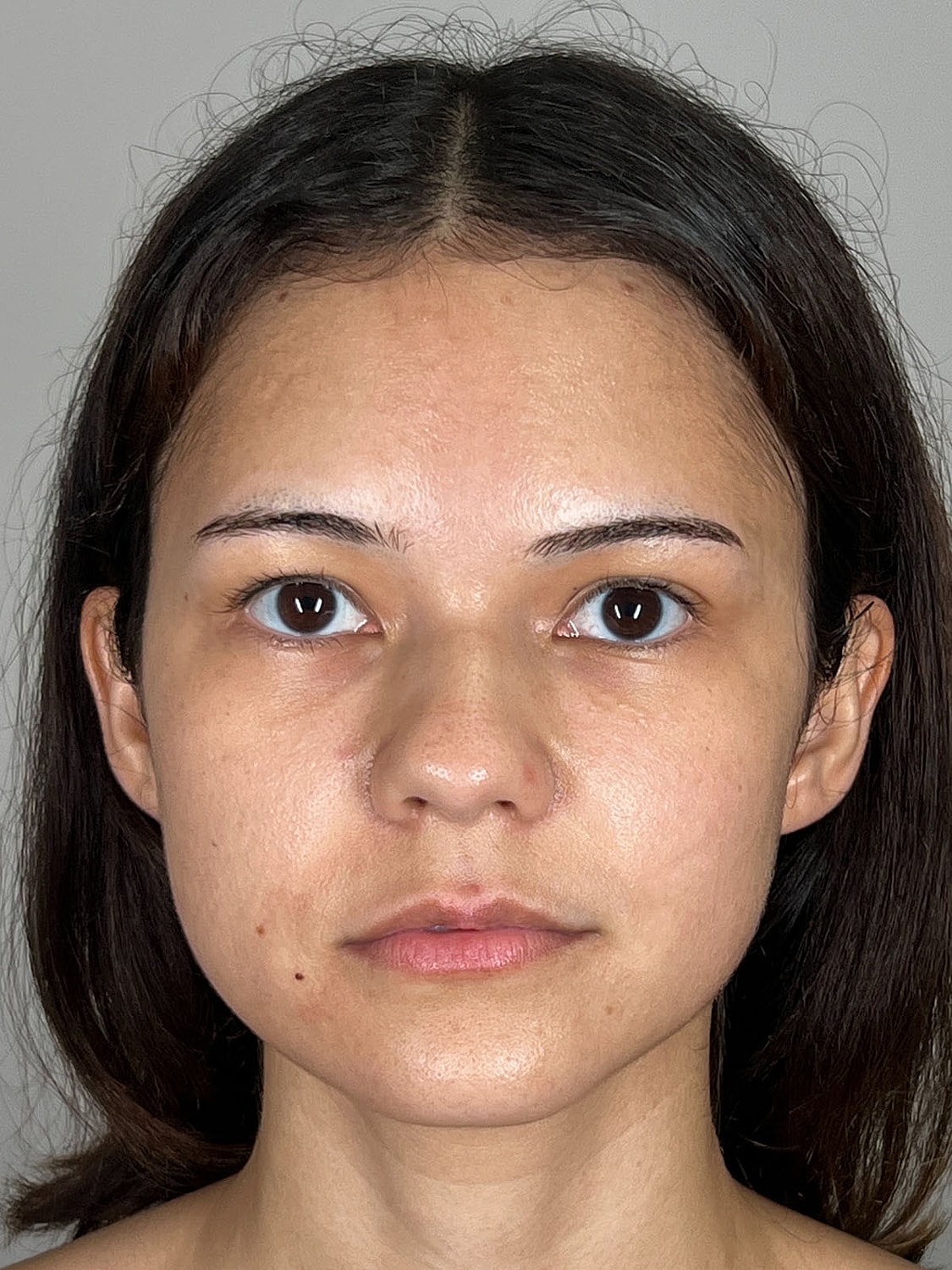 Lip Enhancement Gallery Before & After