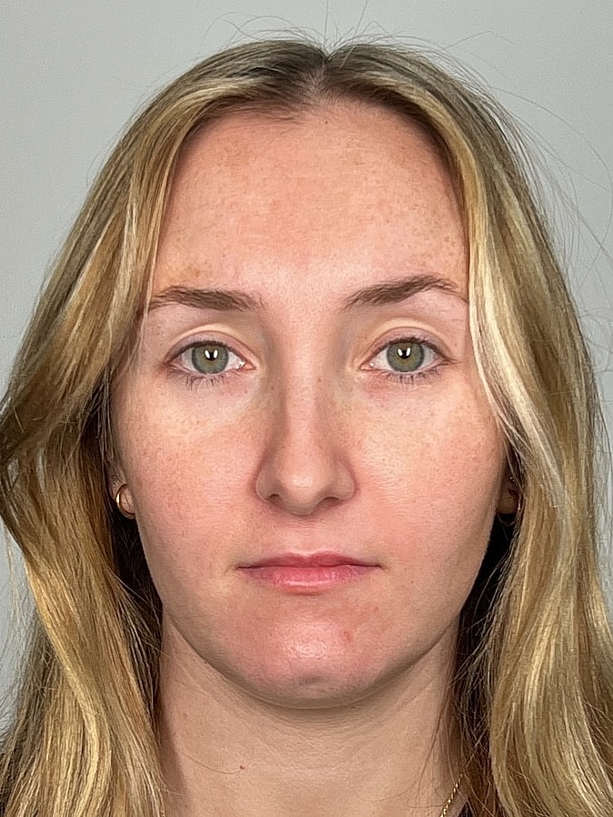Lip Enhancement Gallery Before & After