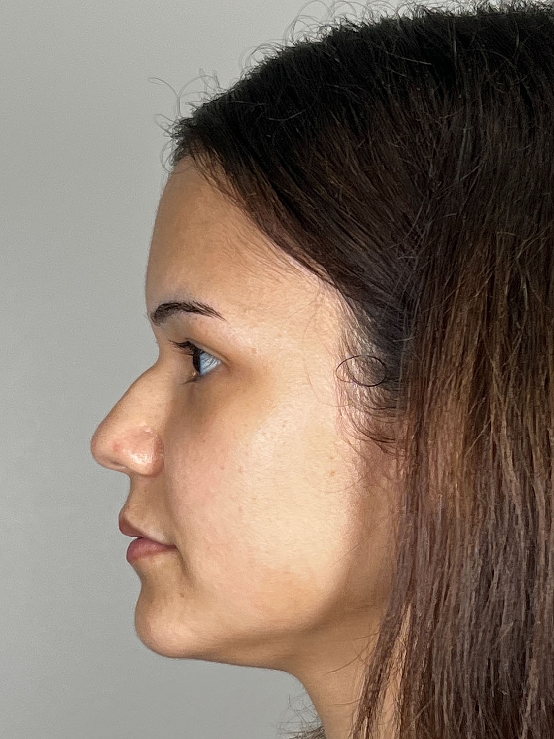 Lip Enhancement Gallery Before & After