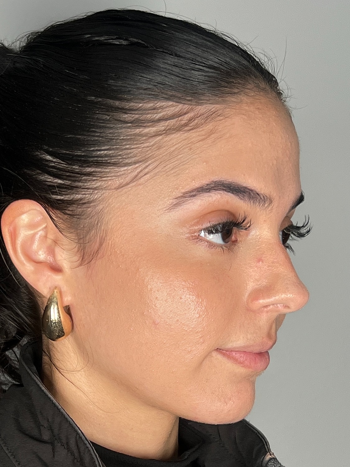 Lip Enhancement Gallery Before & After