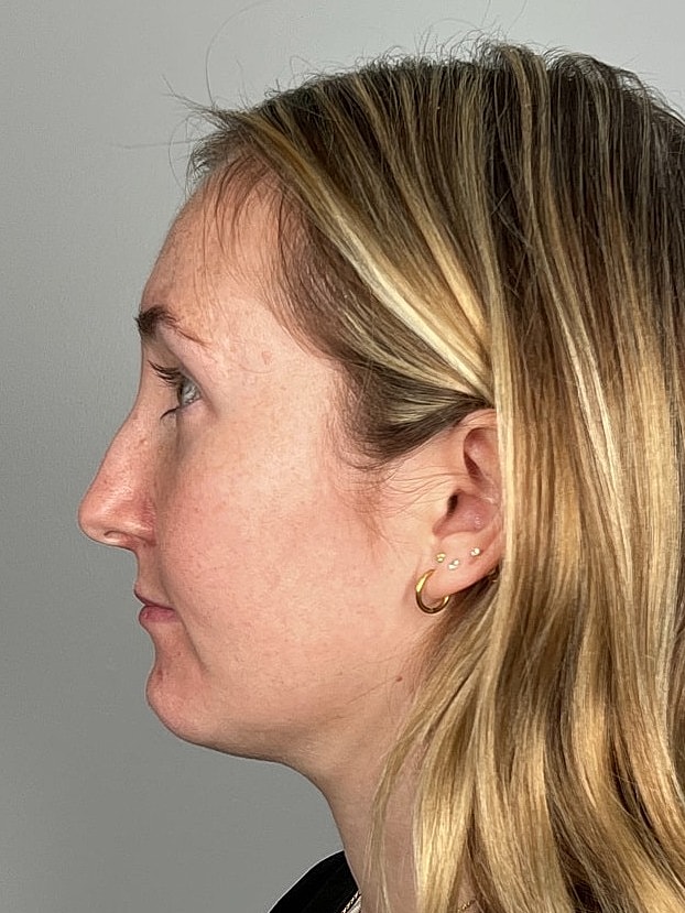 Lip Enhancement Gallery Before & After