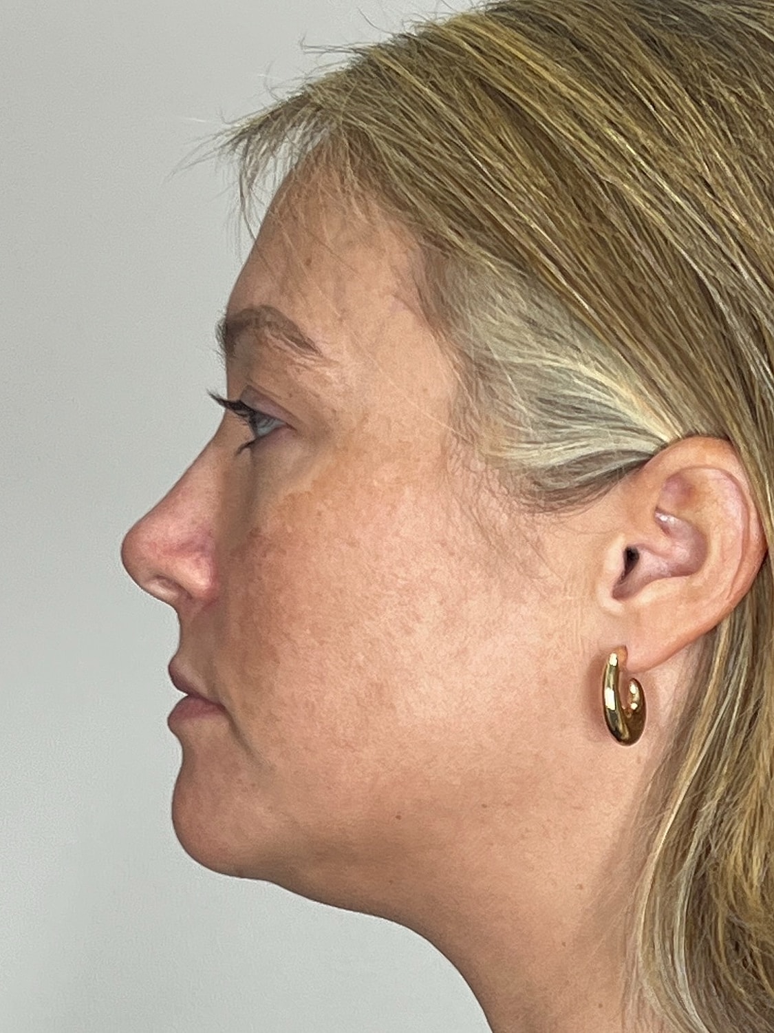 Lip Enhancement Gallery Before & After