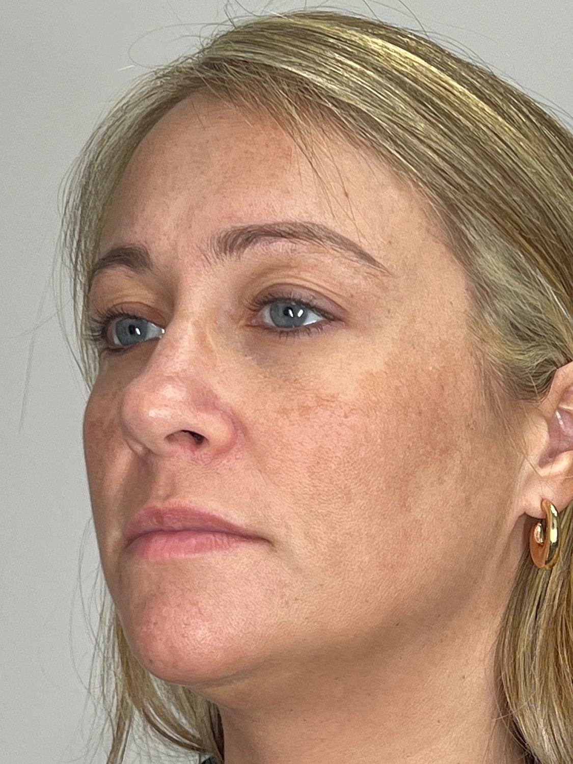 Lip Enhancement Gallery Before & After