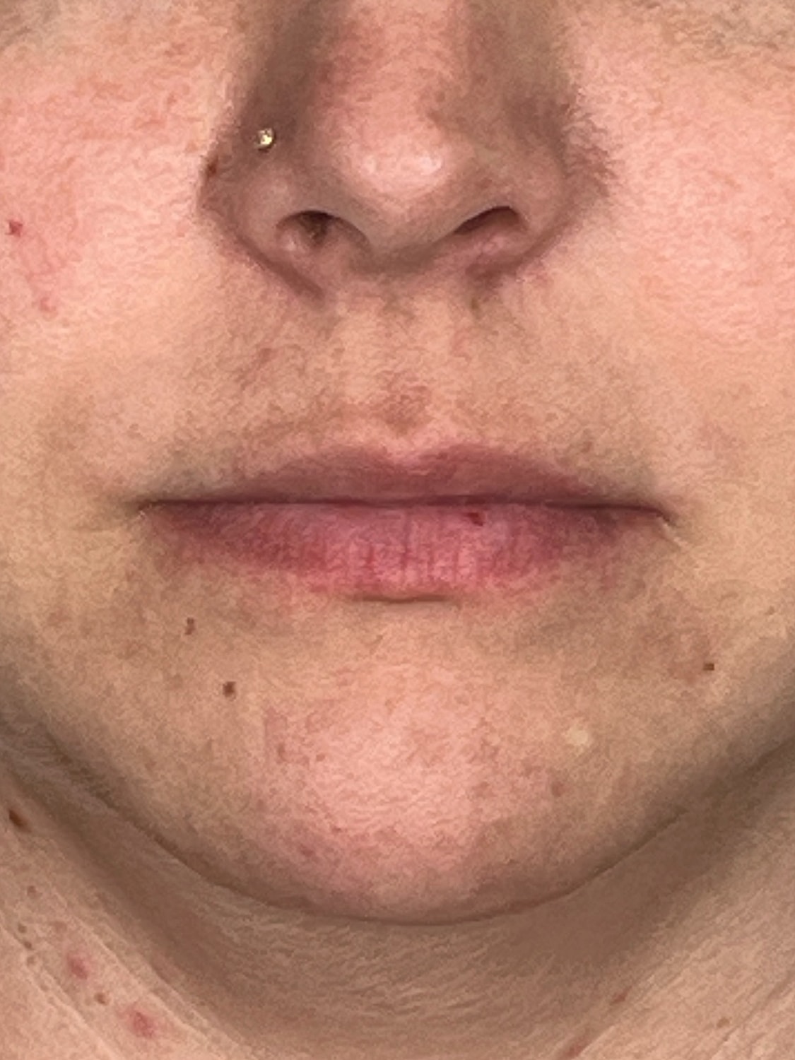 Lip Enhancement Gallery Before & After