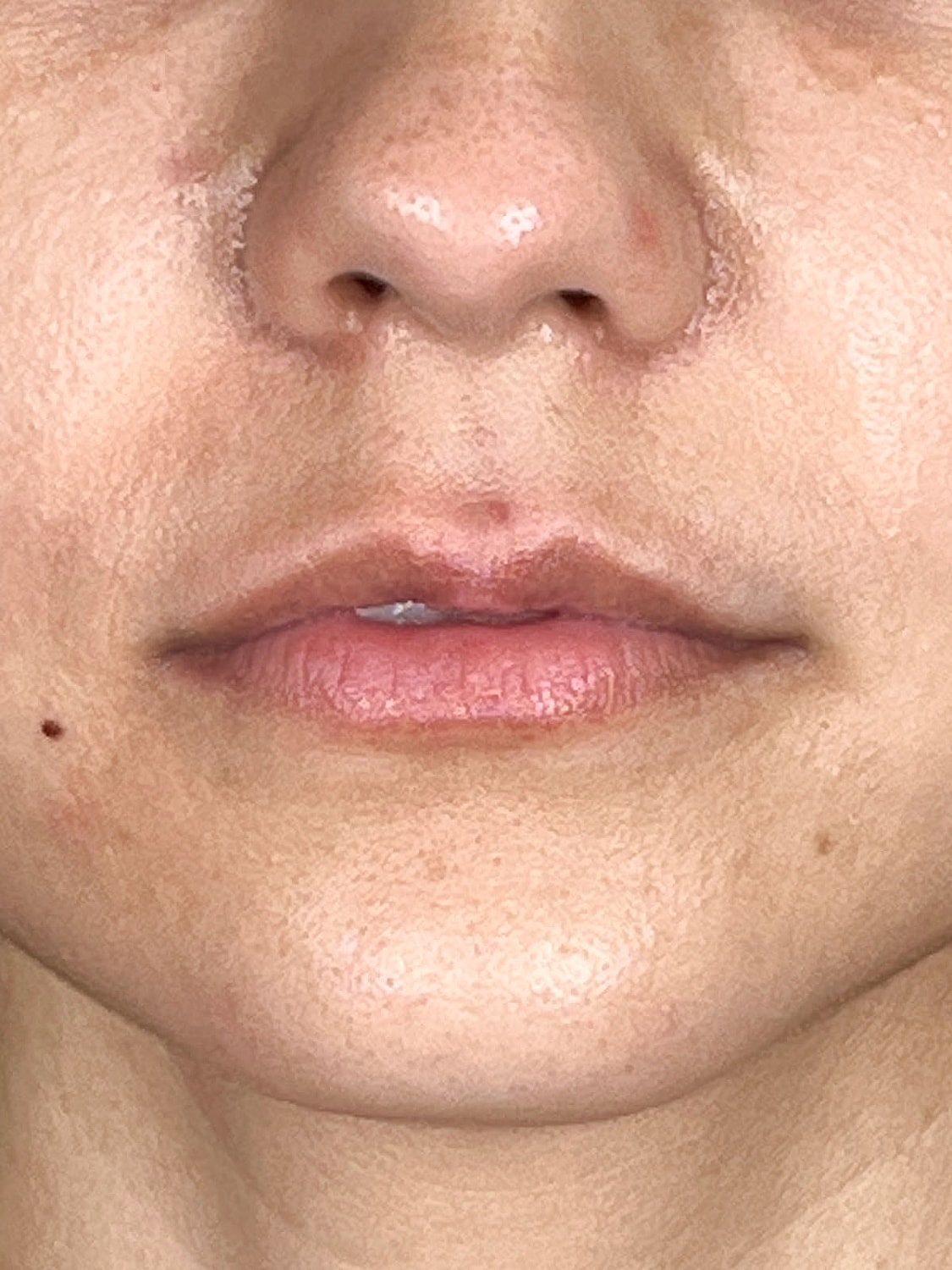 Lip Enhancement Gallery Before & After