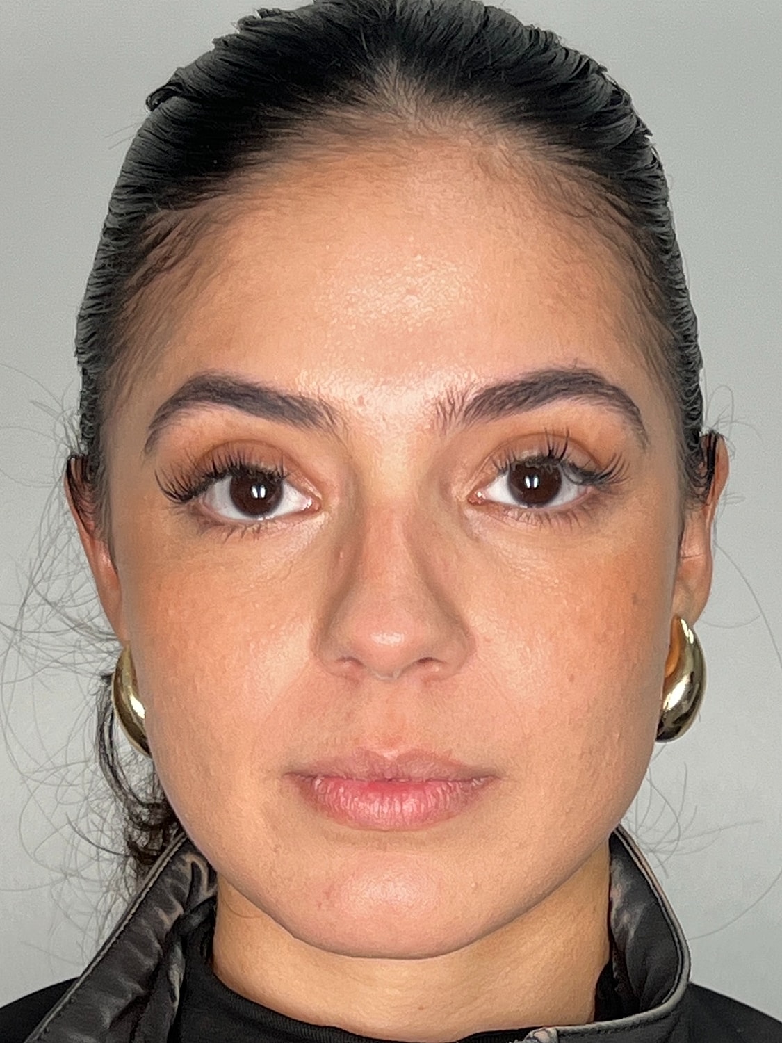 Lip Enhancement Gallery Before & After