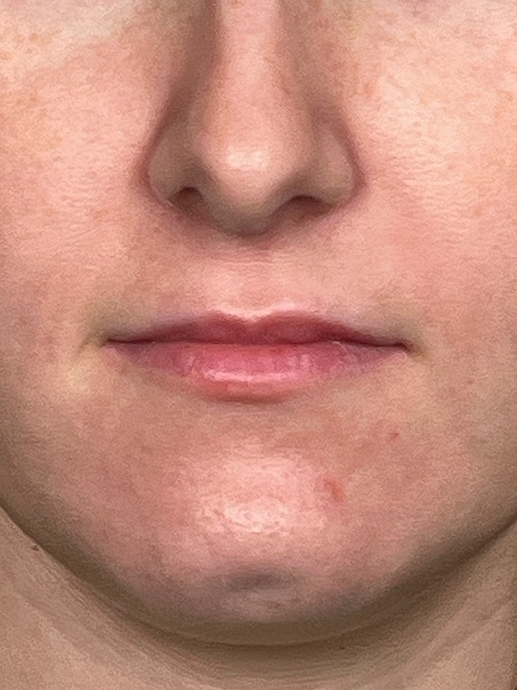 Lip Enhancement Gallery Before & After