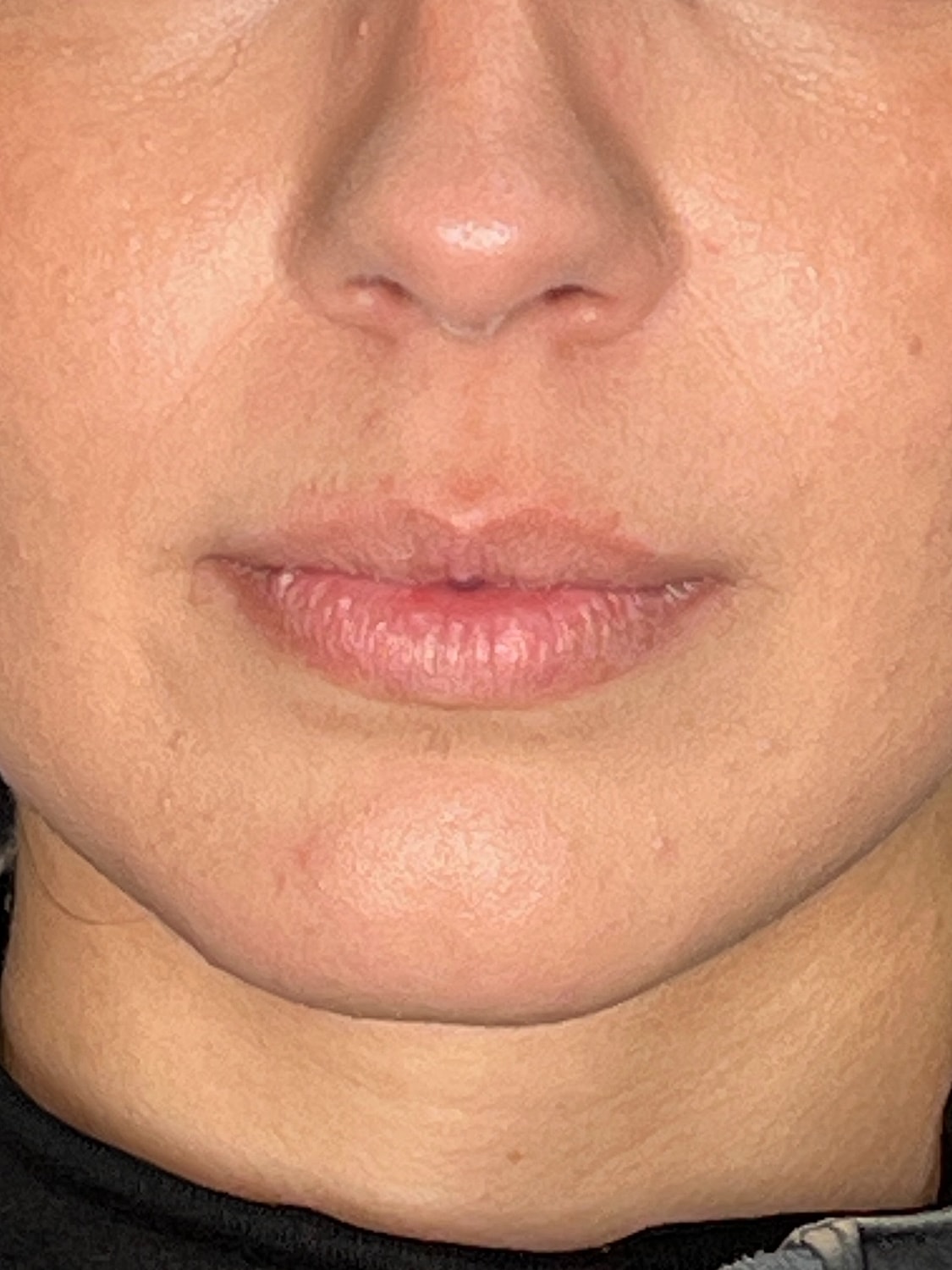 Lip Enhancement Gallery Before & After