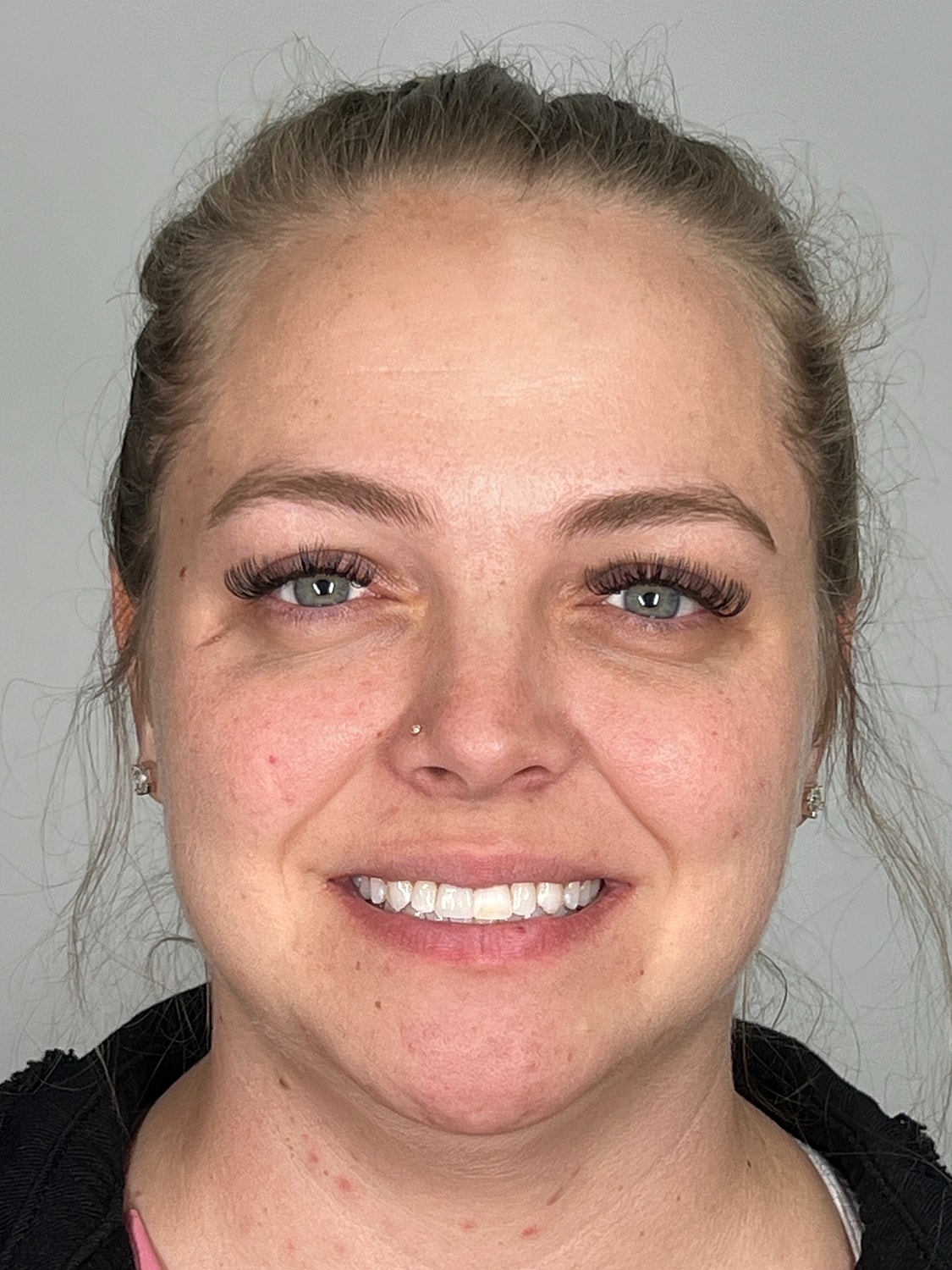 Lip Enhancement Gallery Before & After