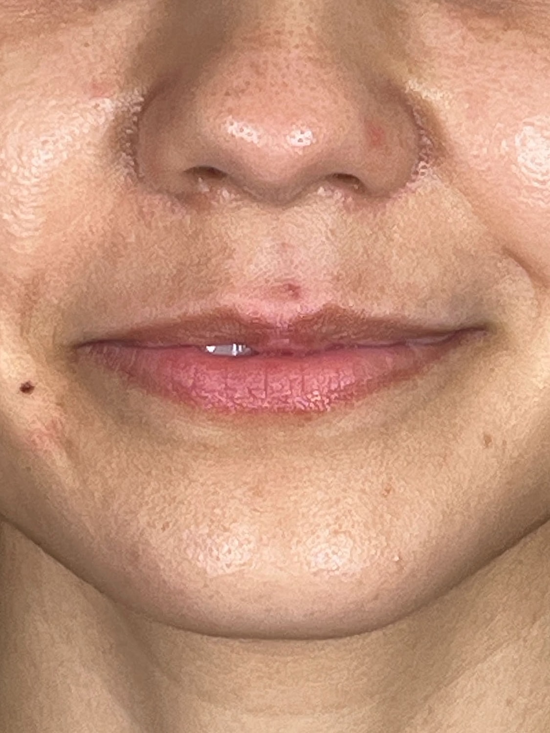 Lip Enhancement Gallery Before & After