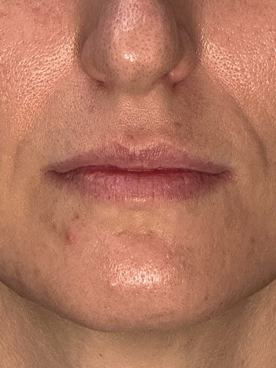 Lip Enhancement Gallery Before & After