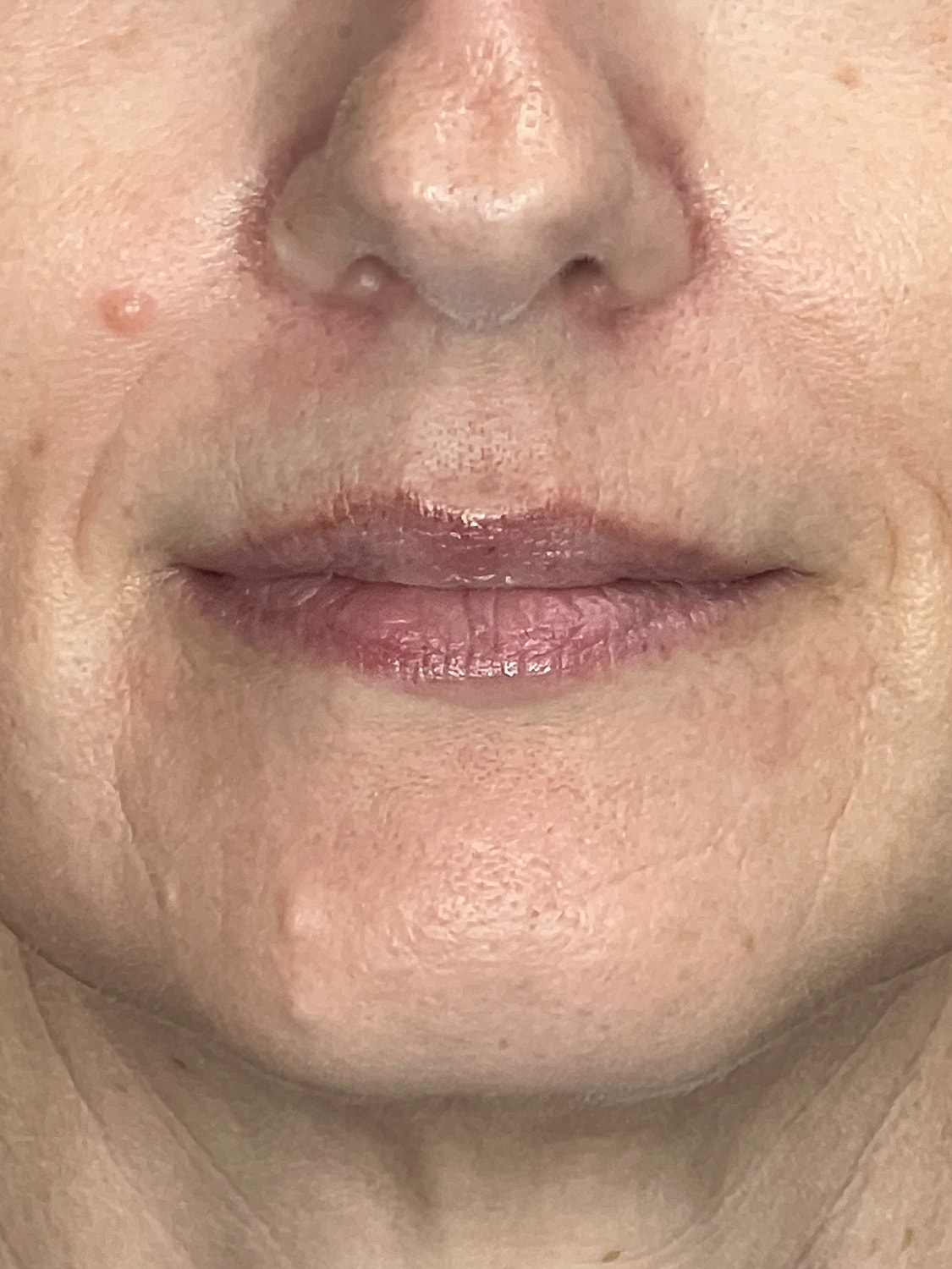 Lip Enhancement Gallery Before & After