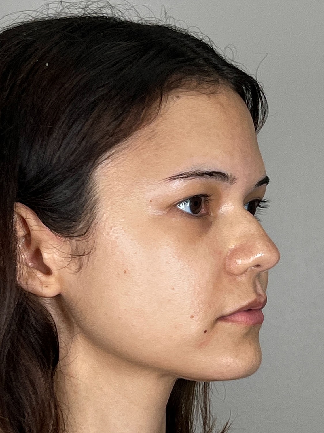 Lip Enhancement Gallery Before & After