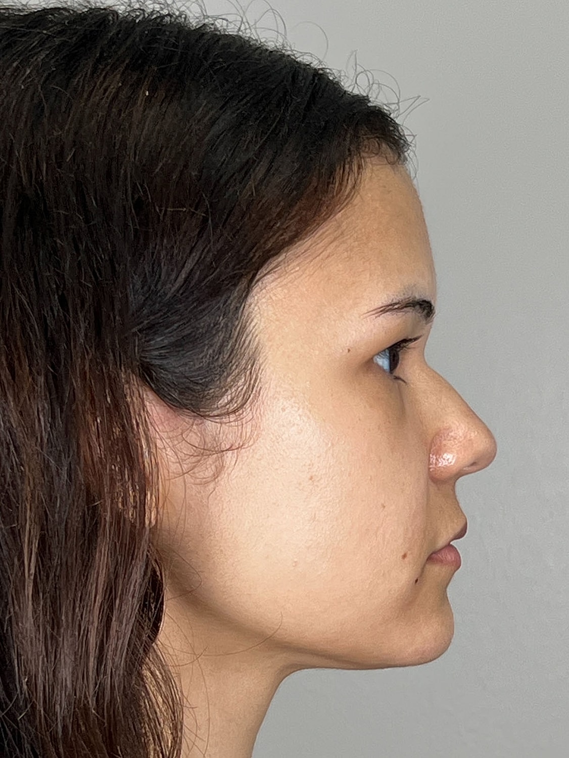 Lip Enhancement Gallery Before & After